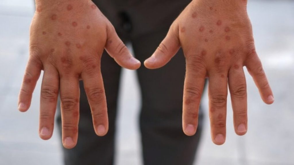 Sobe para 140 número de casos confirmados de Mpox no país, em 2026